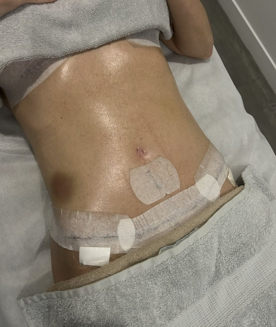 Post-operative lymphatic drainage